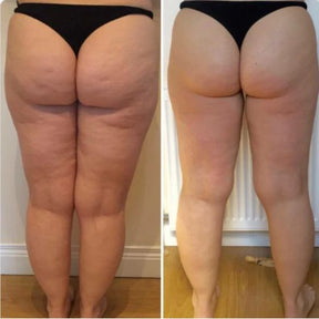 Massageador Anti Celulite + Brinde Óleo de Massagem